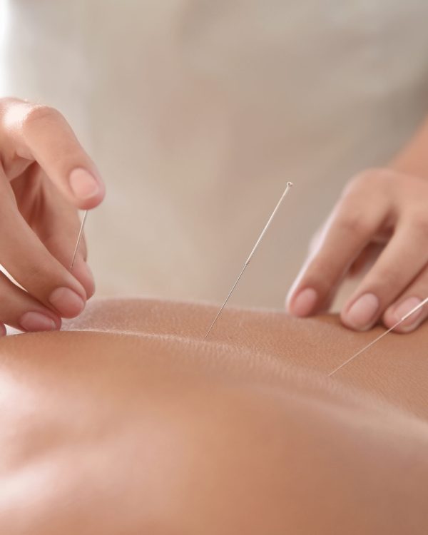 Young man undergoing acupuncture treatment in salon, closeup