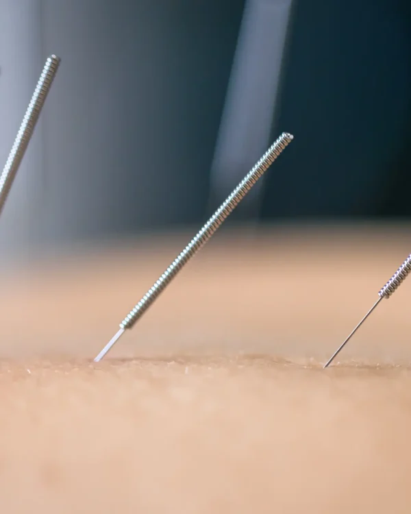 dry-needling-acupuncture-needles-on-patient-close-2026-03-24-04-47-47-utc